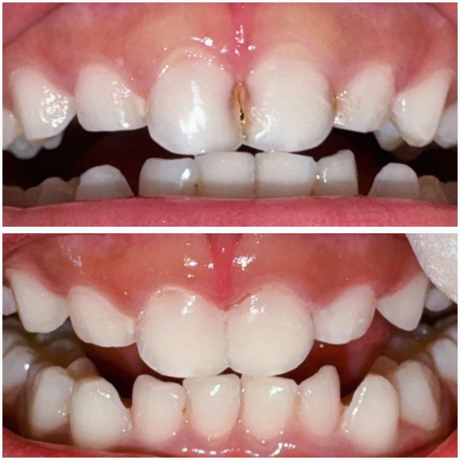 Cavity between upper front teeth