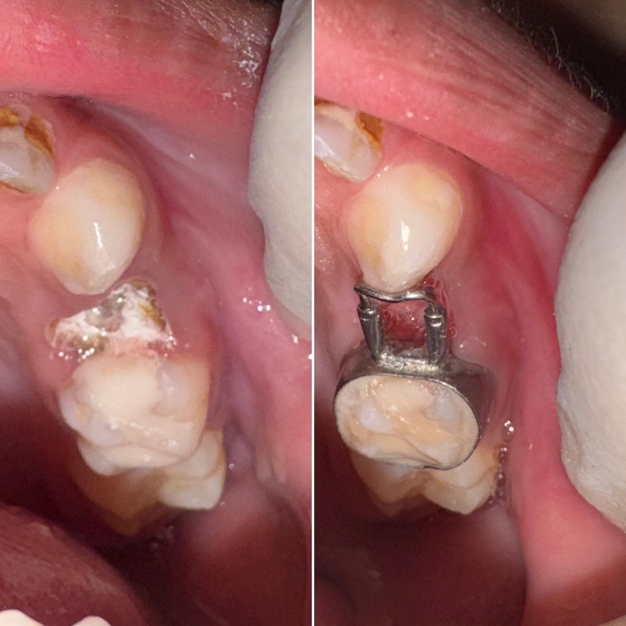 Heavily broken-down primary molar