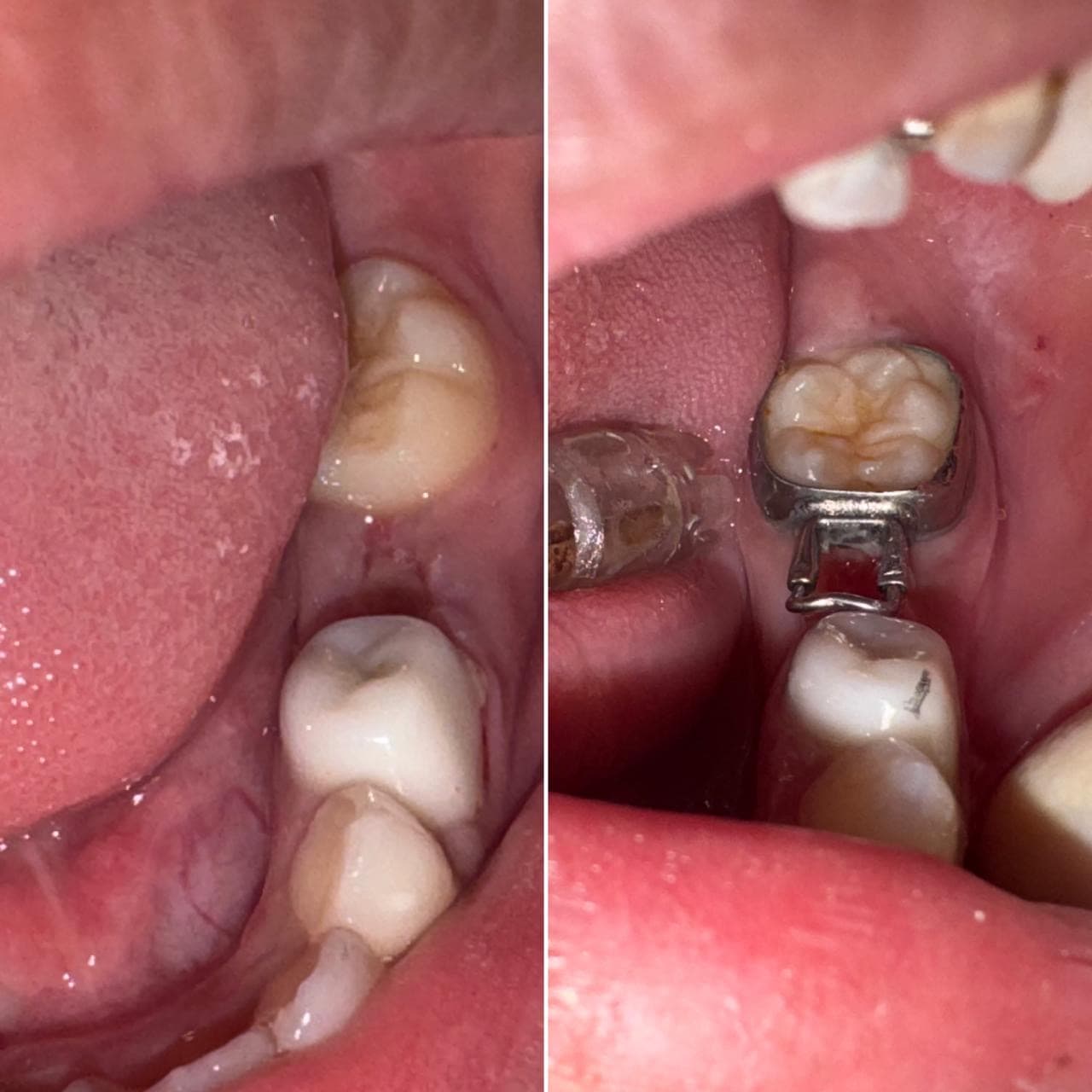 Severely decayed primary molar — stainless steel crown