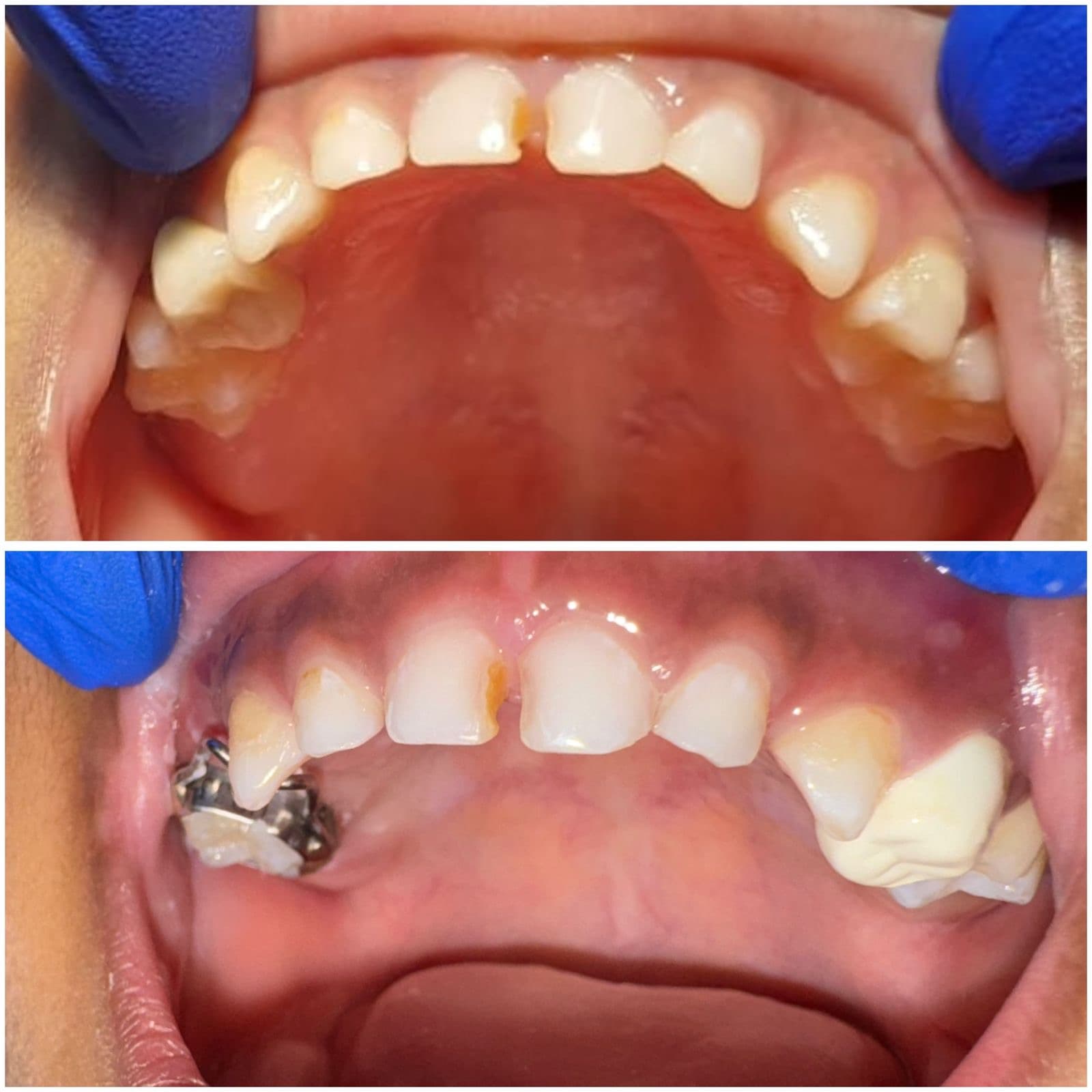 Space maintainer after early primary tooth loss