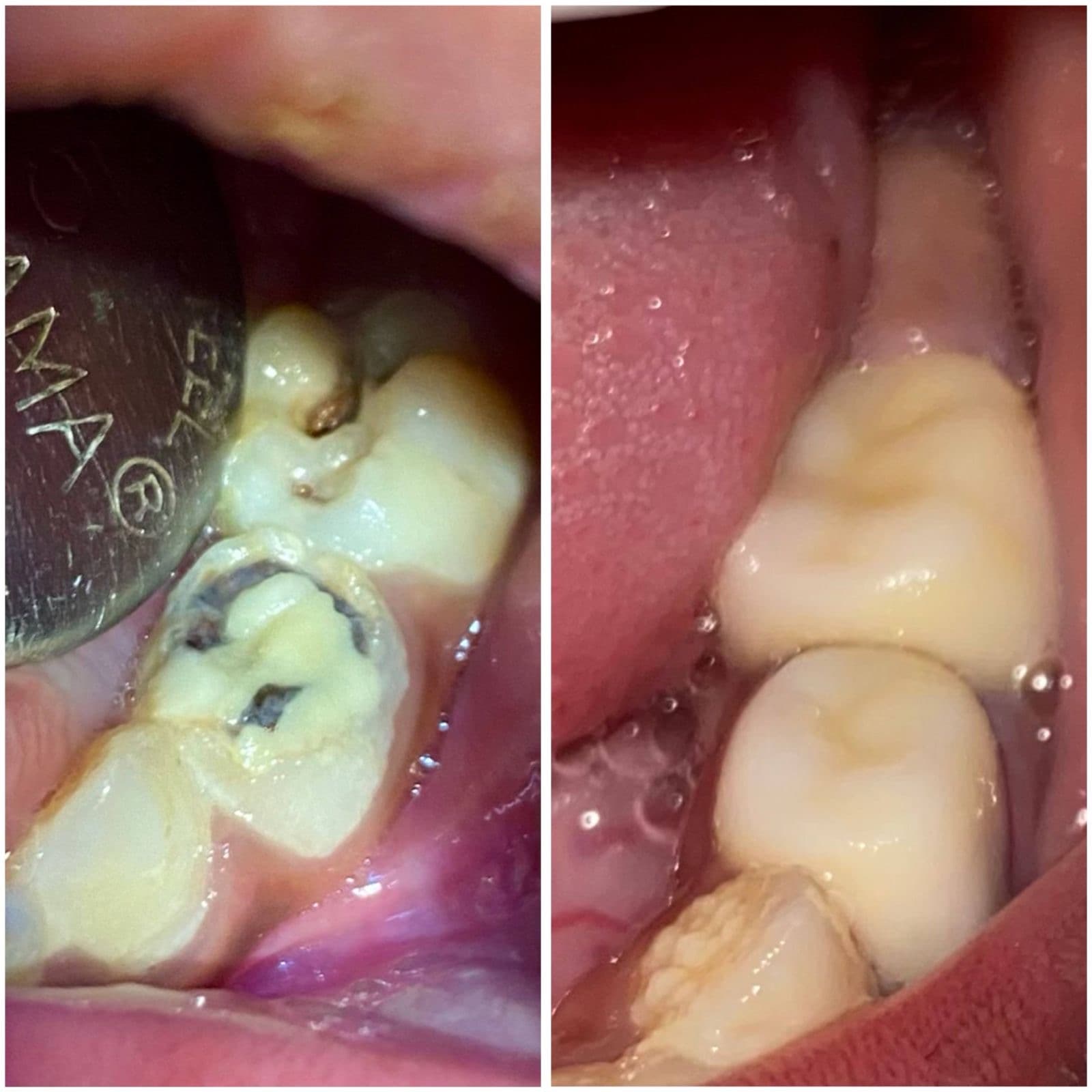 Interproximal cavity, posterior region