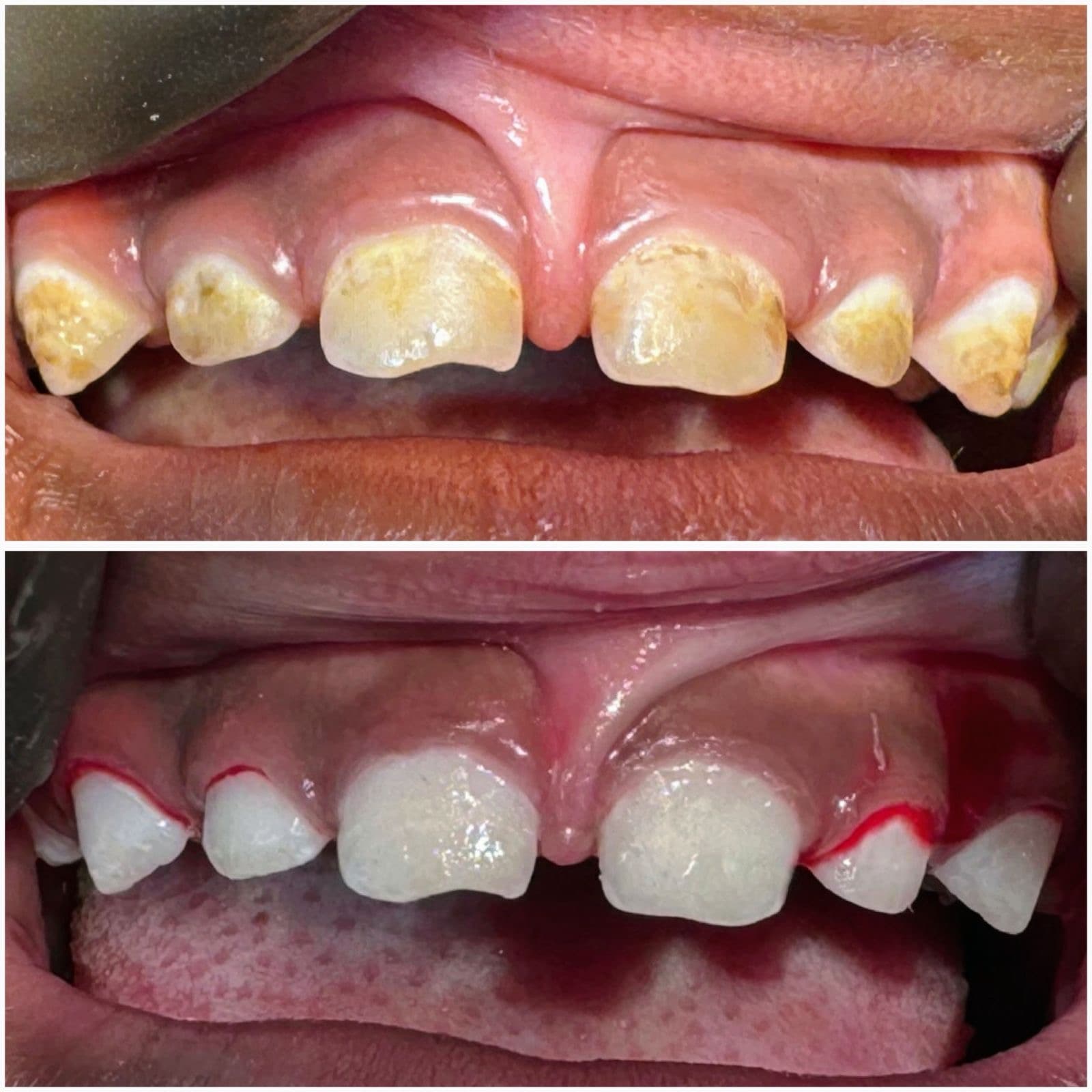 Severe early childhood caries — upper front teeth, age 4