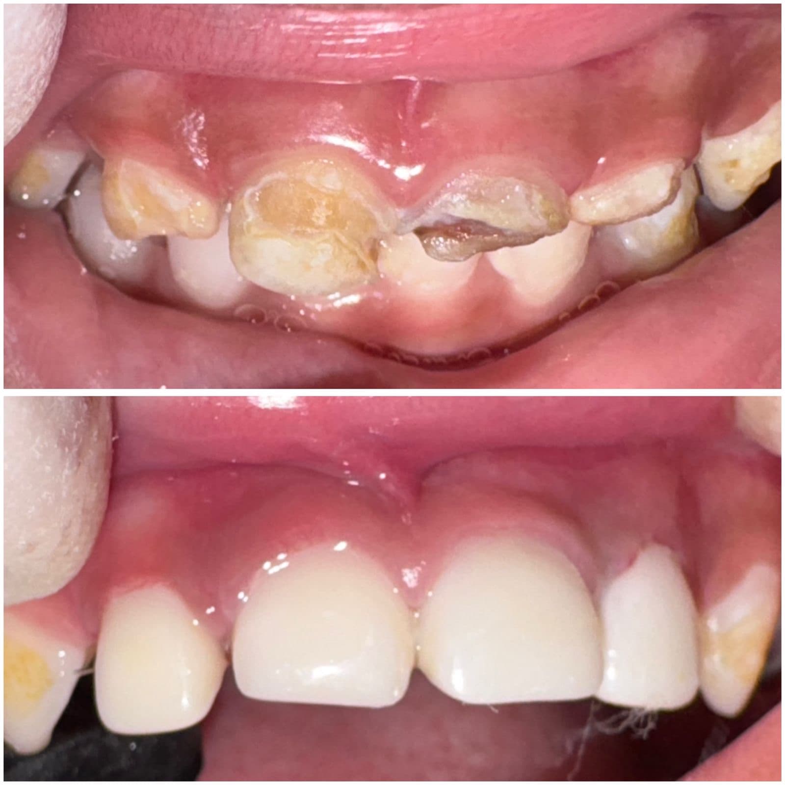 Severe early childhood caries — front teeth nearly destroyed