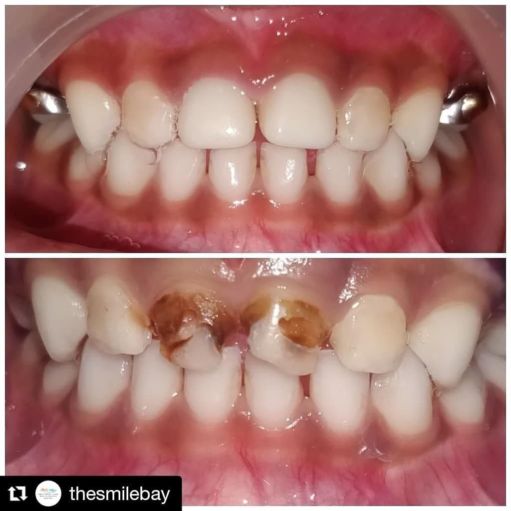 Multiple carious upper anterior teeth